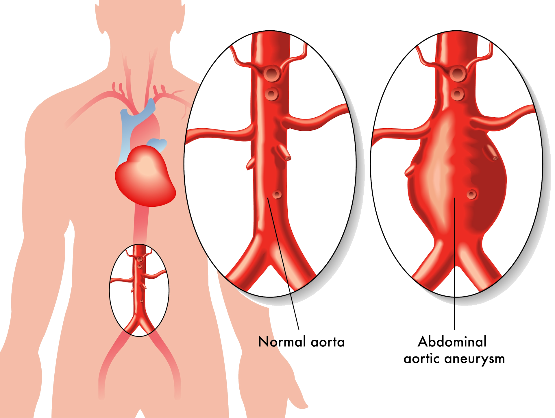 Image showing abdominal aortic aneurysm