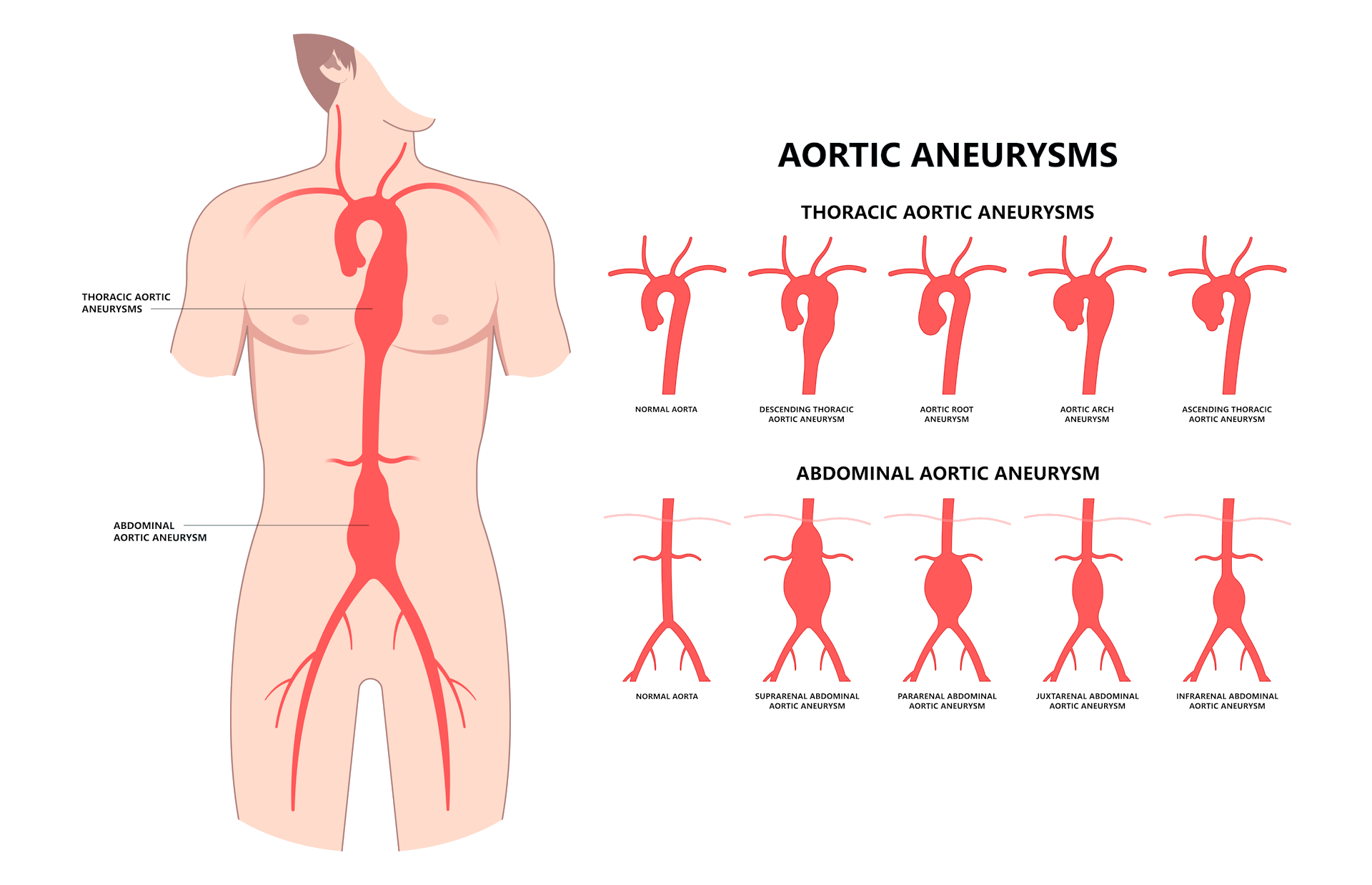 Image showing the different type of aortic aneurysms