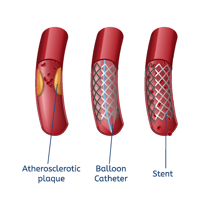 Image showing narrowed artery being treated with balloon and stent