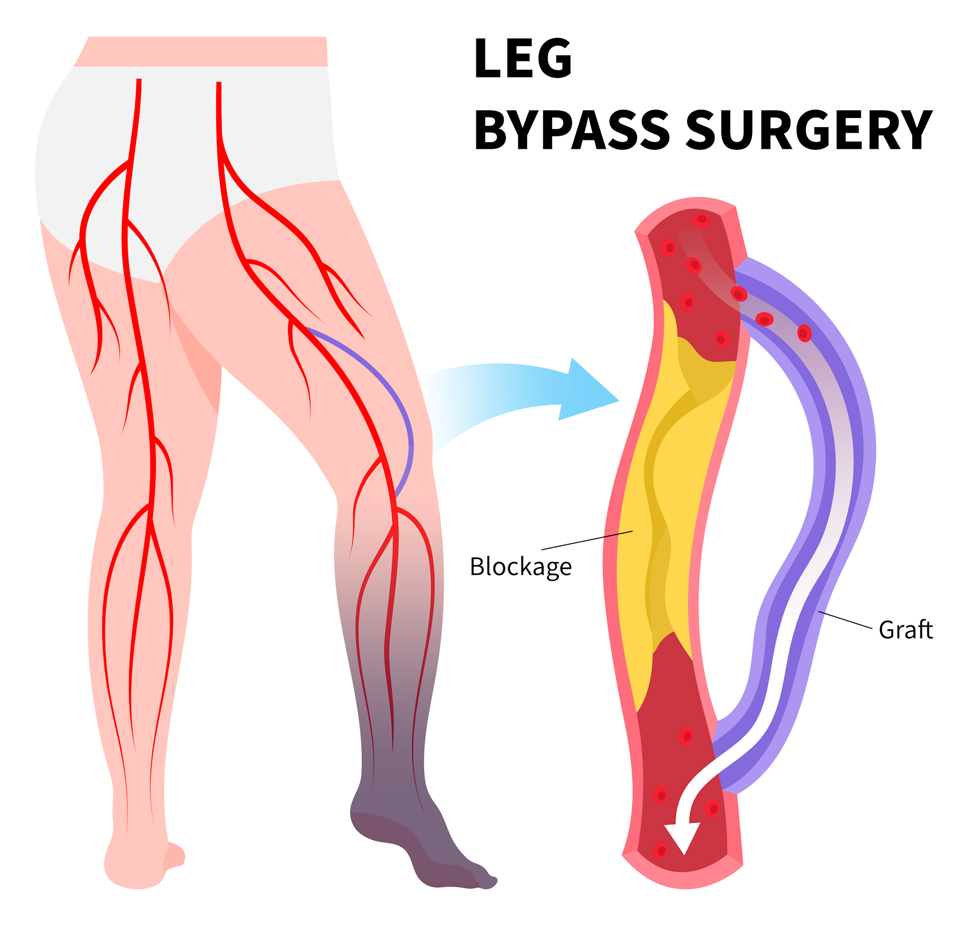 Image showing bypass of the femoral artery