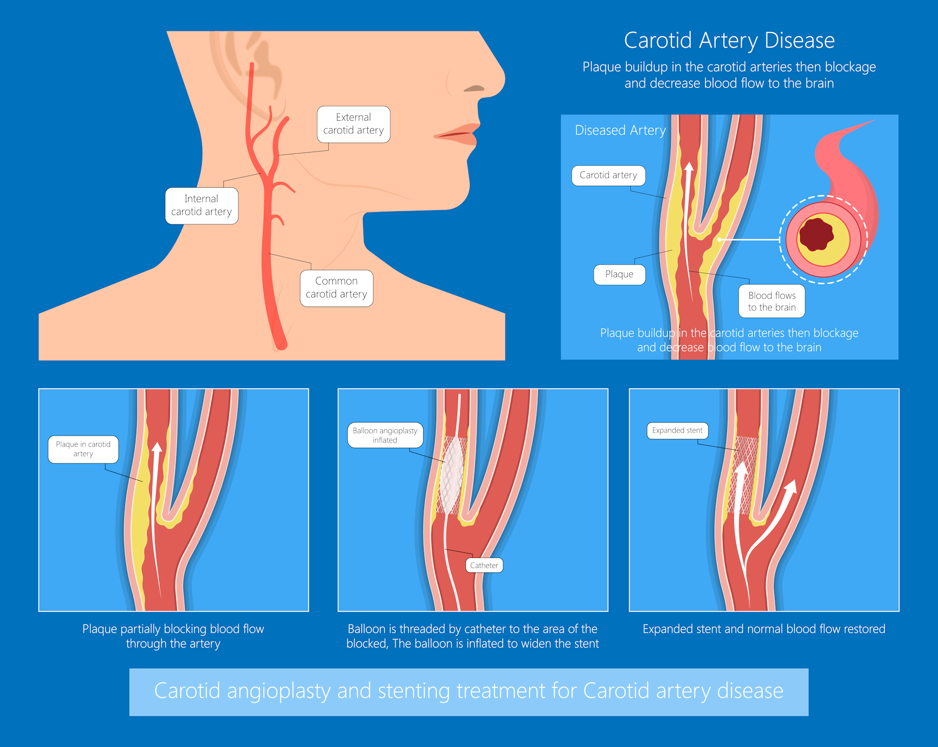 Image showing placement of stent in narrowed carotid artery