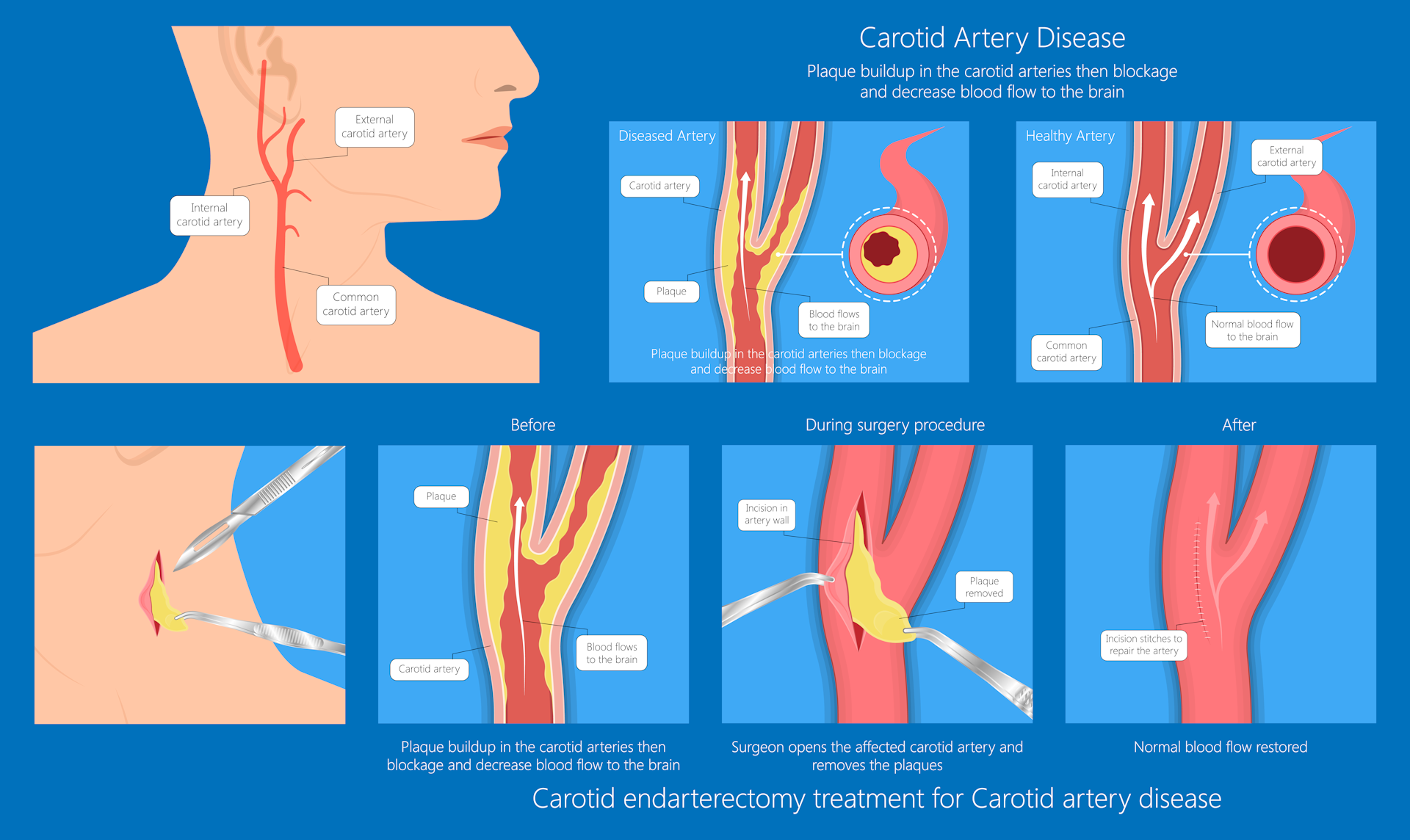 Image showing surgery to remove the narrowing in the carotid artery