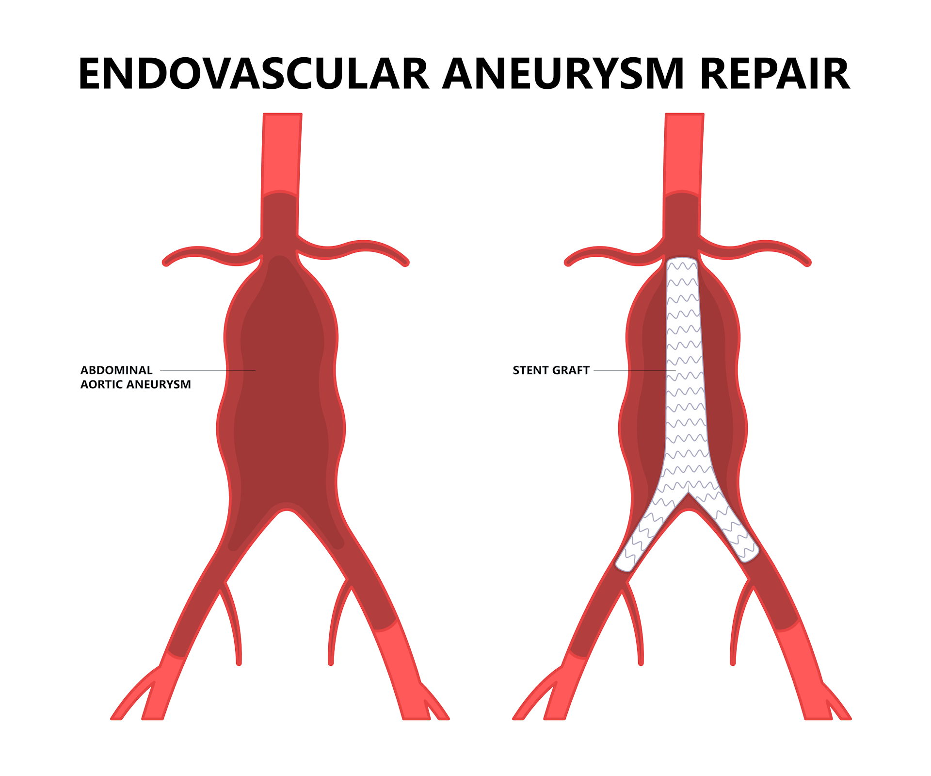 Image showing endovascular repair of abdominal aortic aneurysm