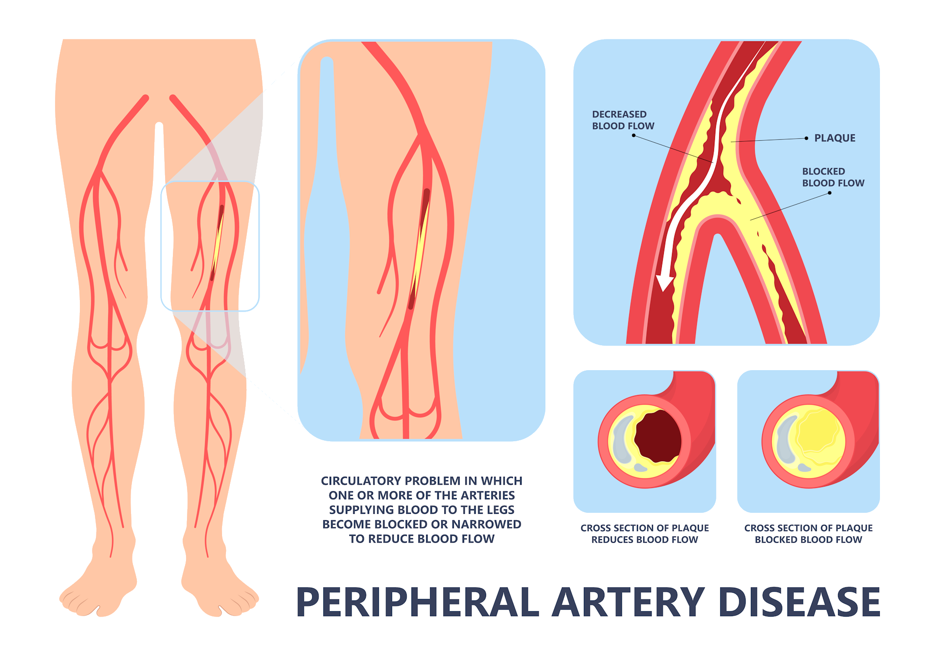 Image showing arteries of the leg with narrowing caused by atherosclerosis