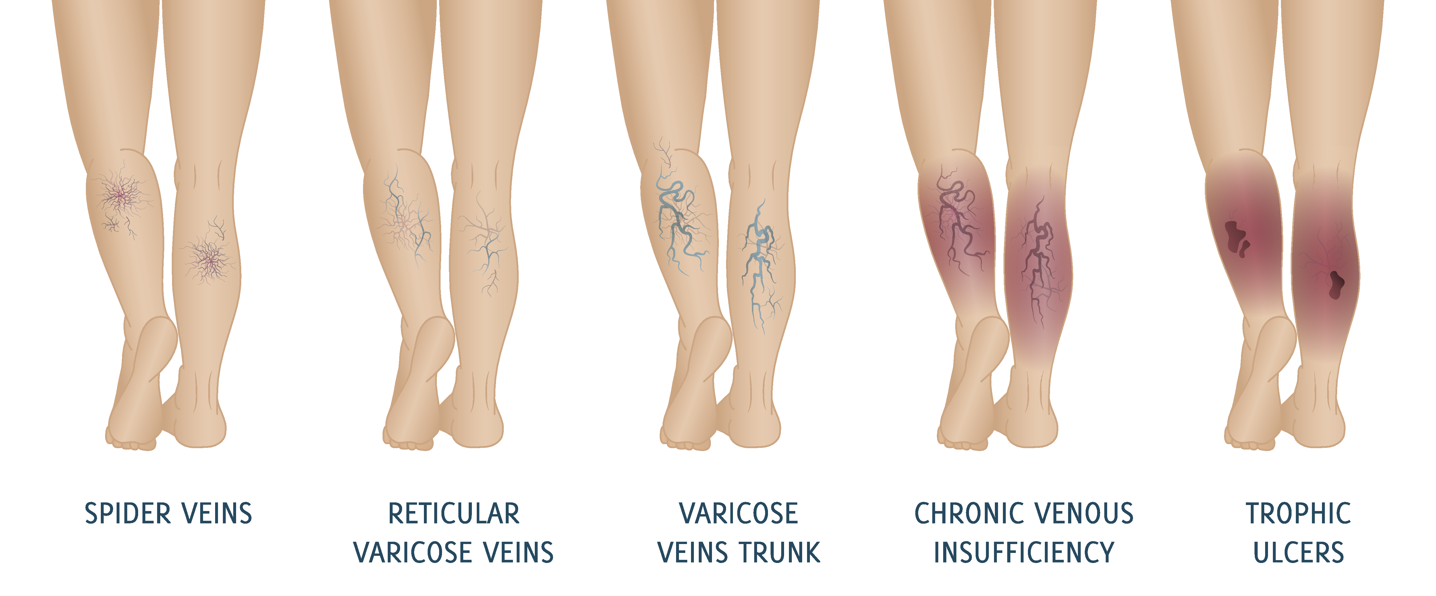 Image showing the stages of varicose veins in the leg